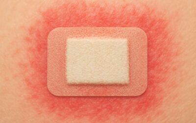 Understanding the Symptoms and Codes of Adhesive Tape Allergy ICD 10